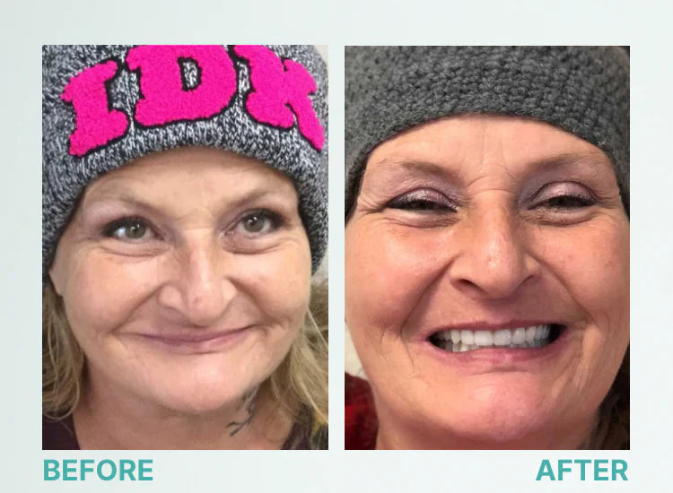 Fit Full Functional Dentures Make you more confident