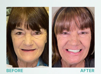 Fit Full Functional Dentures Make you more confident