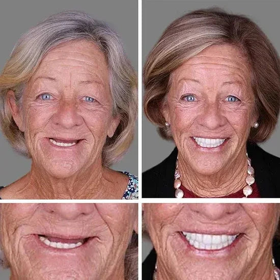 ⏰Ends Today: 70% OFF! 🌎Demany™ Medical Full Denture with Strong Suctiond🦷Obtain American Dental Association (ADA) Certification
